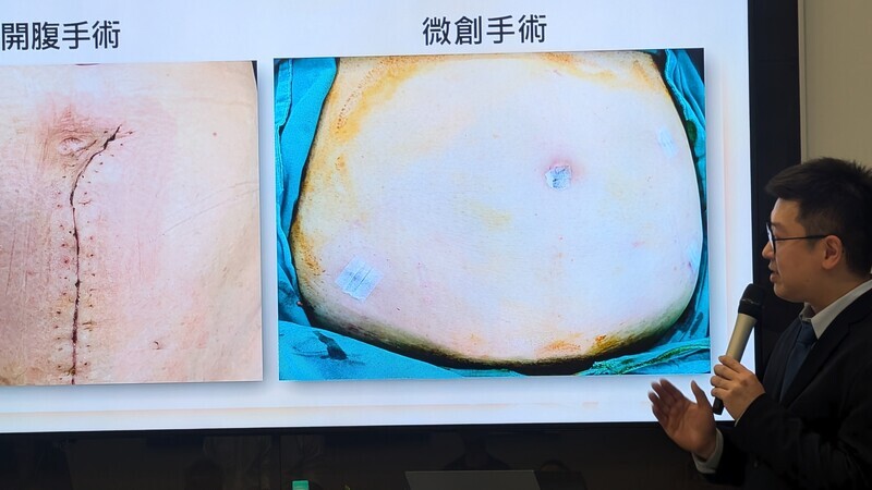 曾憂手術影響生育避就醫 機械手臂助摘子宮肌瘤