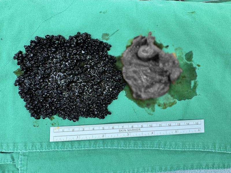 吃火鍋後腹痛開刀 取出大量「魚子醬狀」膽結石