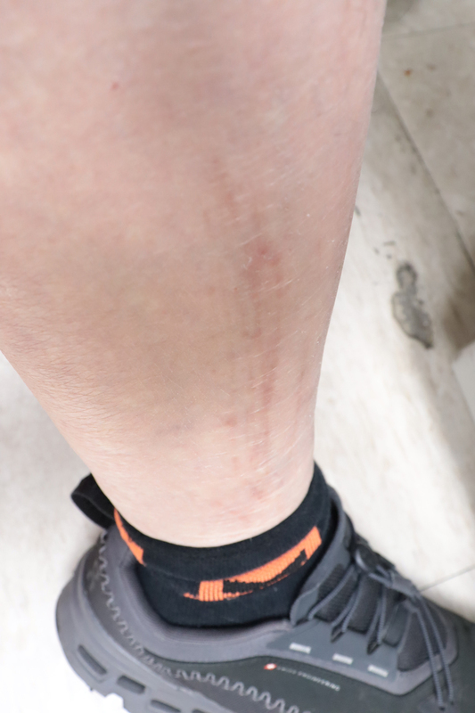 骨頭痠痛奇癢無比　中年男被診斷副甲狀腺功能亢進