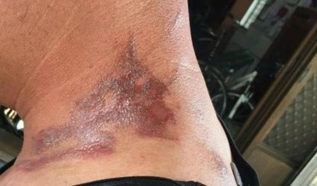 里長陳建州脖子遭隱翅蟲的毒液腐蝕。