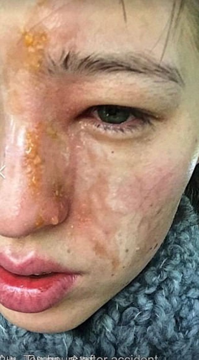 愛蜜莉半張臉遭化學灼傷(翻攝每日郵報)