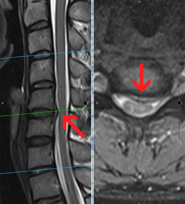 患者頸椎5至6節椎間盤突出。(翻攝光田綜合醫院官網)