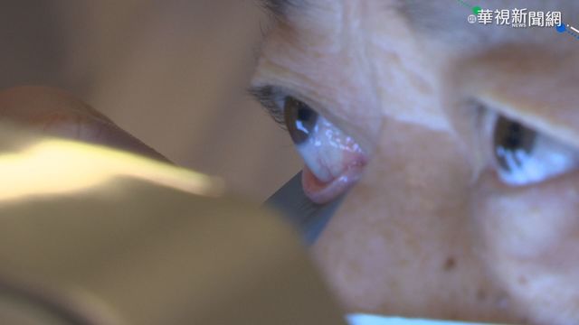 1/3國人罹乾眼病 眼科醫:年齡層下降