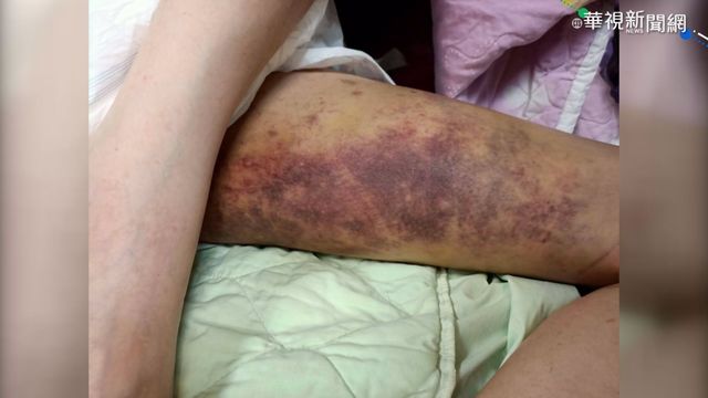 護理之家虐住民? 院方駁斥.衛局追查