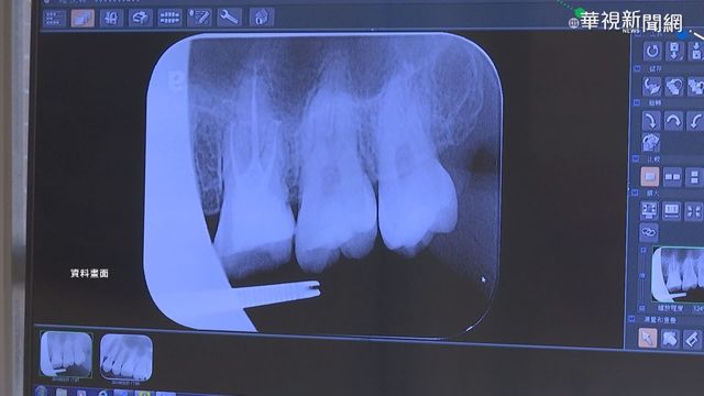 醫改會:植牙糾紛占牙科醫療投訴3成