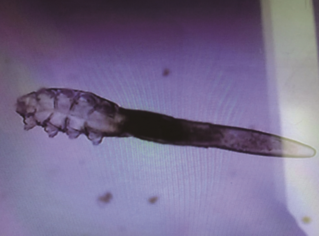 （醫生檢查發現陳小姐的睫毛根部長滿蠕形蟎蟲，翻攝自中媒）