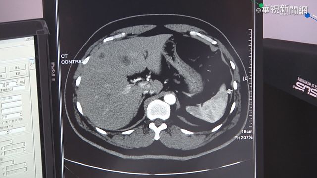一家三代5人罹腸癌 遺傳機率50%