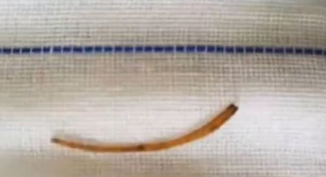 他肛門一直覺得被頂…就醫驚見：卡3公分害他痛