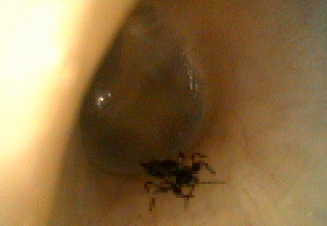 她「耳鳴還很癢」以為外耳炎 醫一看驚：蟲蟲危機