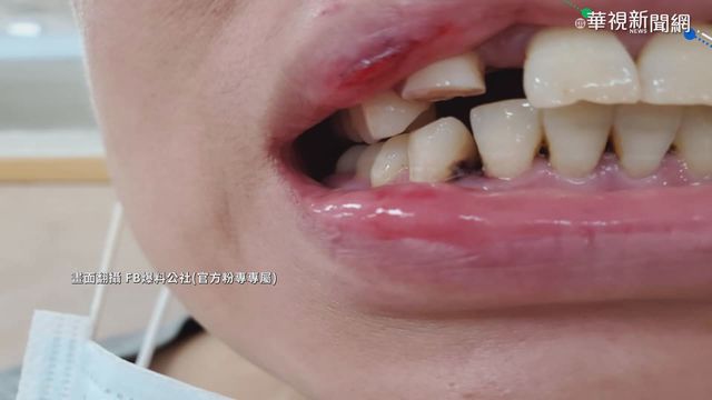 夜市路面不平 女摔斷門牙提告