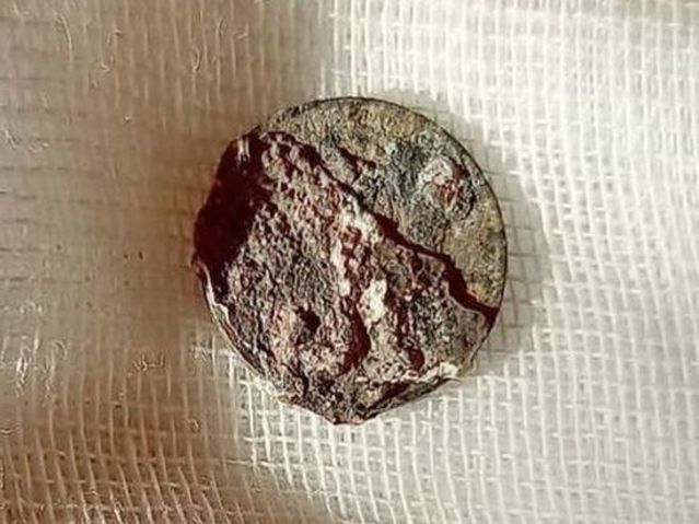 59歲男呼吸困難疑染疫 就醫驚現鼻塞15公厘硬幣