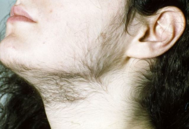 醫療疏失釀禍！腸胃藥誤混生髮素 吃完竟「全身長毛」