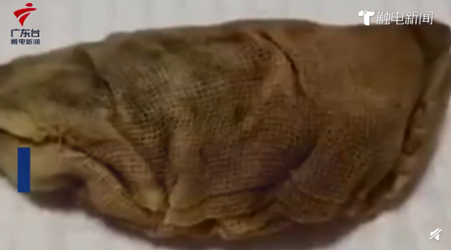 醫院從童女士體內夾出一塊紗布（翻攝微博）