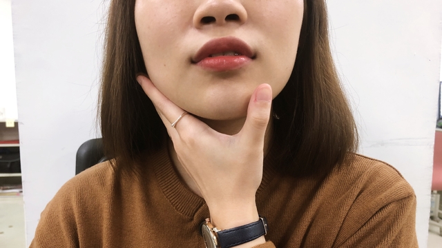 女大生下巴「反覆腫脹」像青蛙... 醫：唾液腺結石