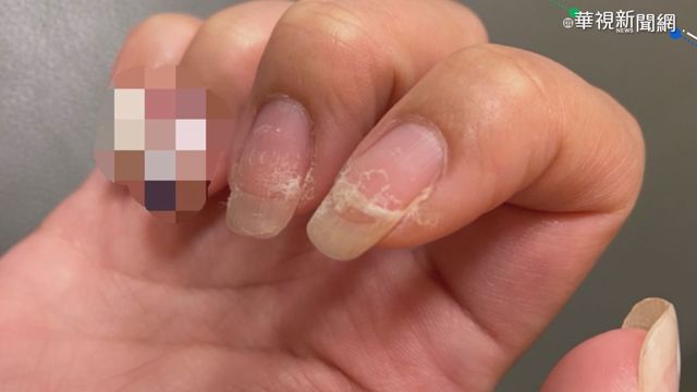 女子定期指甲光療 甲面受損成魚鱗