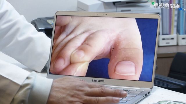 阿公｢腳皮屑｣掉滿地 2歲童染香港腳