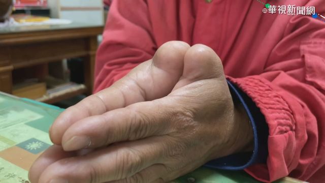 關節多1cm 雙手大拇指遭截肢｢非身障｣