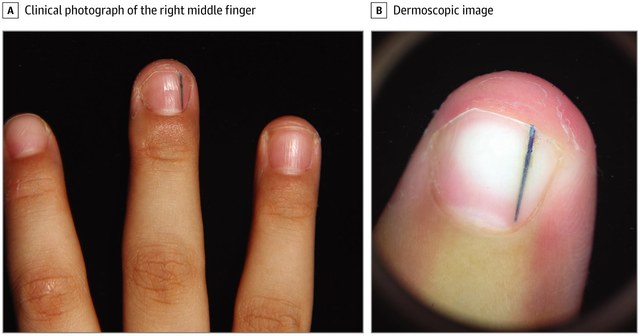 以為是痣！男童指甲突現1條黑線 原來是「史萊姆」惹禍