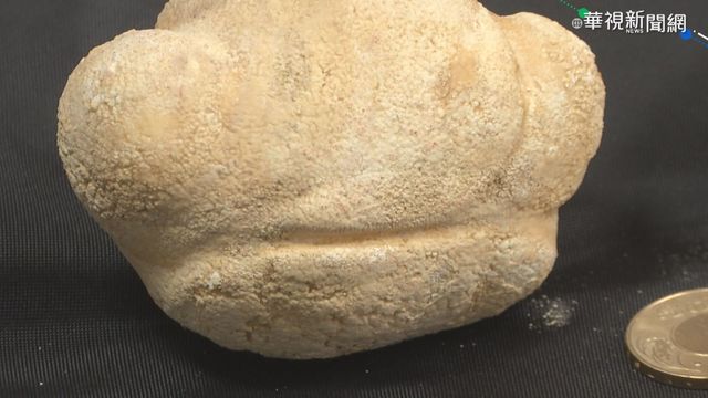 老婦膀胱結石大如棒球 急手術取出