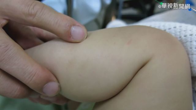 膝蓋起小紅疹! 9月大男嬰染腸病毒
