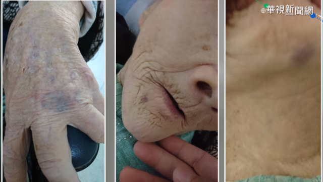 長輩手腳瘀青紅腫 家屬控訴安養中心