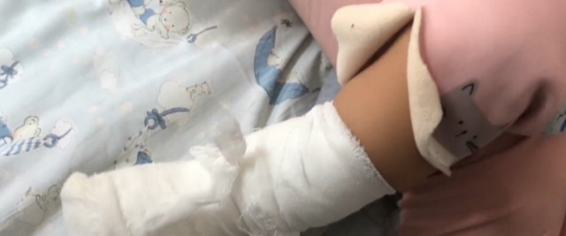 暖暖包爆炸害嬰燙傷。(翻攝自《新浪網》)