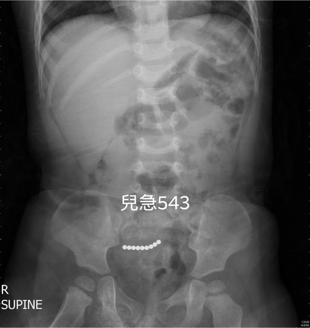 3歲童一夜狂吐 X光驚見「巴克球」已致腸穿孔...