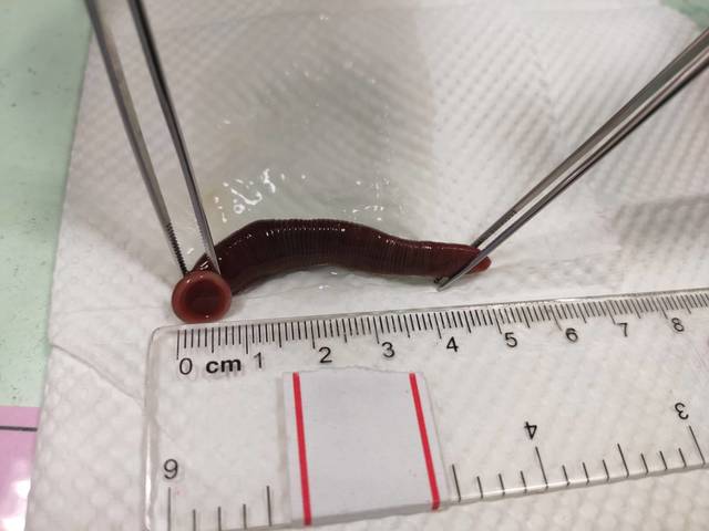 他莫名狂流鼻血數月 就醫竟夾出「5cm水蛭」