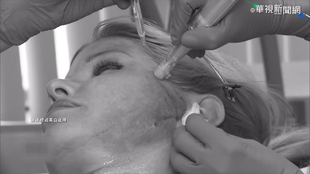 「以血換血」回春療程 愛美代價高