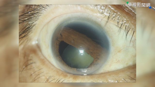 被羽球｢殺球｣擊中眼睛 男子視力僅0.4