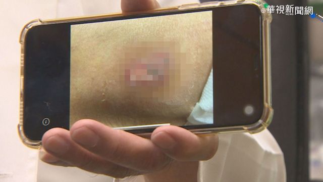 蓋電熱毯追劇被燙傷 男子大腿起水泡