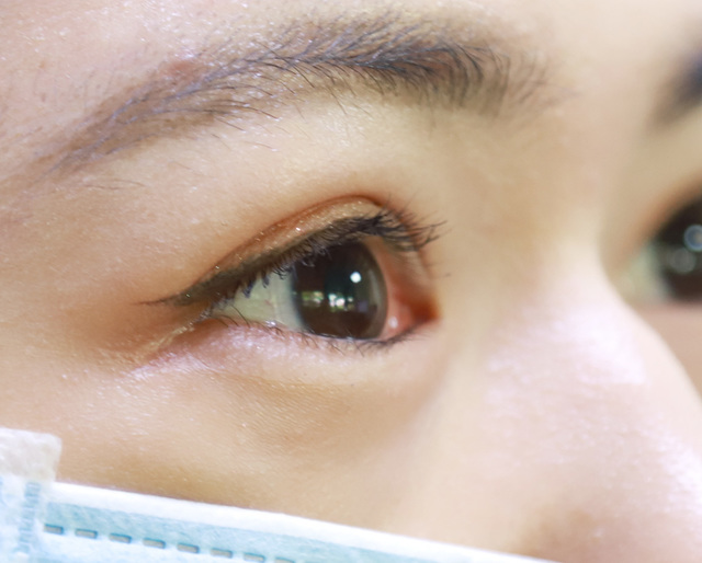 女高中生常點眼藥水 「這成分」害眼壓飆高險失明