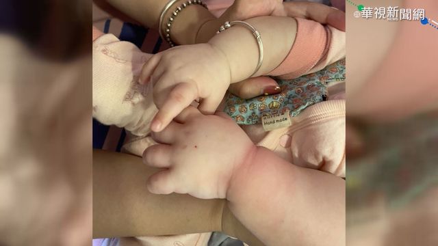 女嬰打點滴手指腫脹變色 醫院致歉