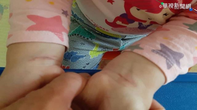 2歲女童手腕瘀傷 家長懷疑幼園體罰