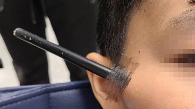 玩耍出意外！80公分箭矢「射進7歲男童右臉」