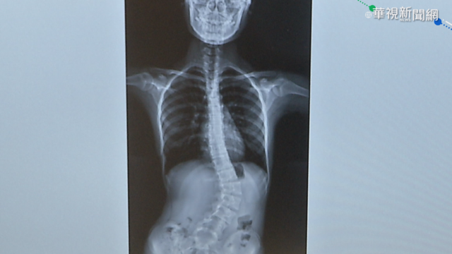 小五女童腰痠背痛 就醫竟是脊椎側彎