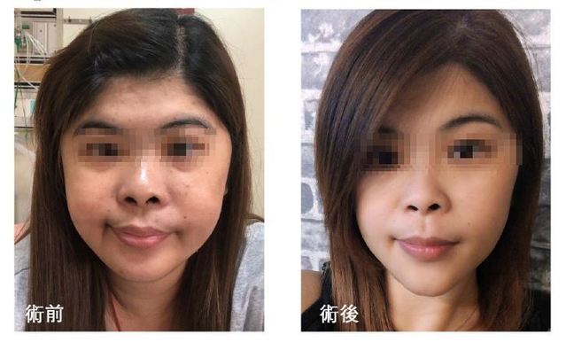 生活習慣沒變體重卻暴增15公斤 「庫欣病」惹的禍！