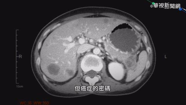 沉默的隱形殺手!6大癌徵兆難發現