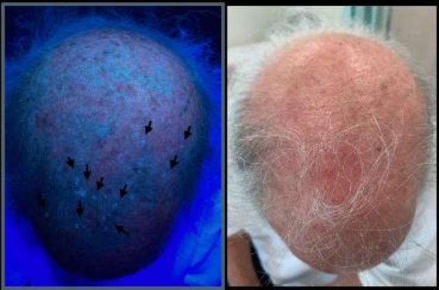皮膚長斑.發癢擦藥卻無效 醫：恐為皮膚癌前病變