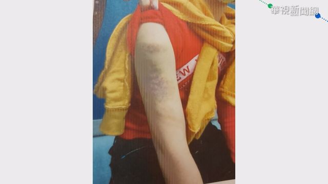 疑作業寫太慢 補教師失控怒毆小二童