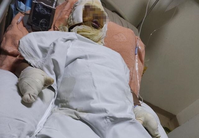 等面試抽菸「瞬間爆炸」 送醫仍掛念：還有房貸要還…