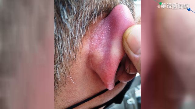 中國製口罩品質差 引發耳廓軟骨膜炎