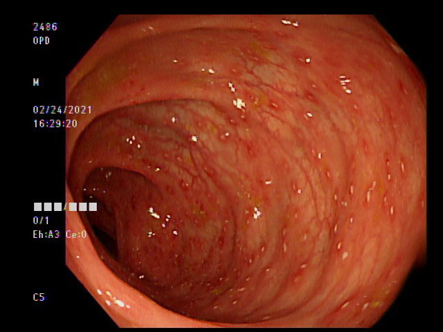 大腸鏡影像 白色點為阿米巴原蟲（亞大醫院提供）