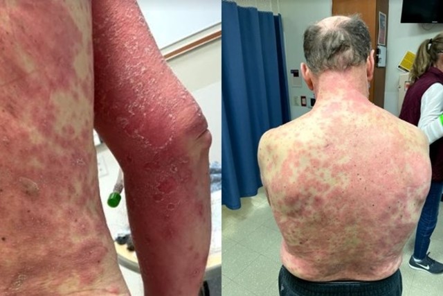 嬌生疫苗出包？ 美國男子全身紅疹、四肢腫痛