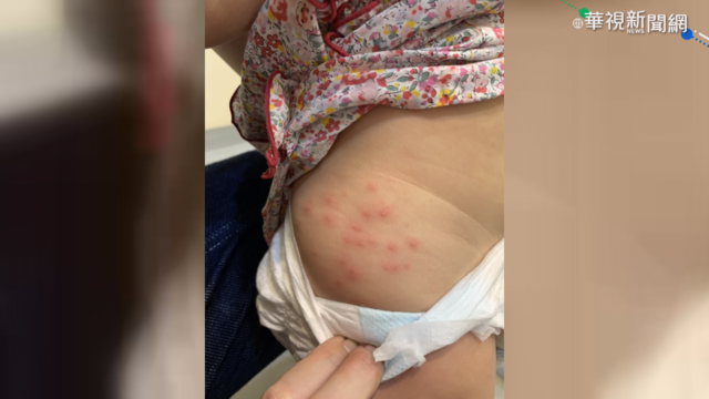 女童大腿起疹子 毛毛蟲剛毛導致過敏