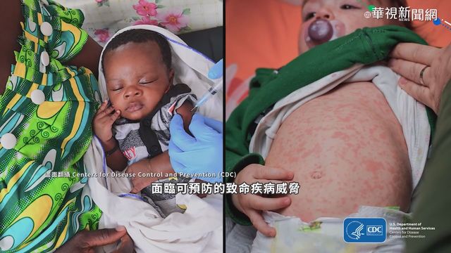 疫情打亂例行接種 葉門.巴基斯坦爆麻疹
