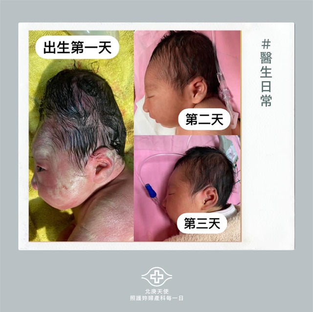 寶寶出生「頭顱超長」阿嬤急壞 醫勸：快點拍照