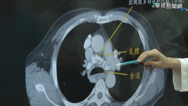 高雄大叔頻吐白色石頭 竟是塵肺症!