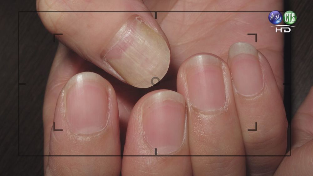 免搶買血氧機！ 醫師傳授「看指甲」簡單檢測法