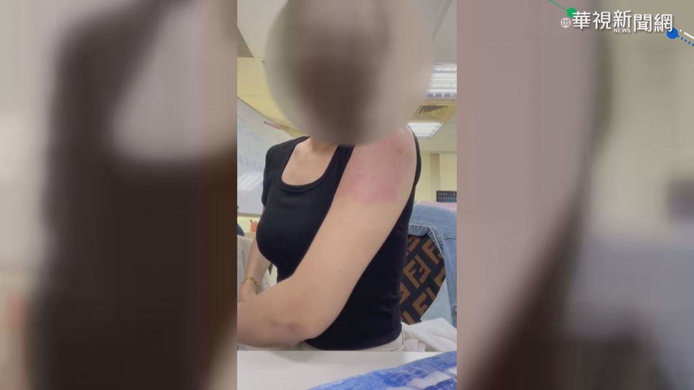 延遲性過敏! 男打莫德納3天後長紅疹